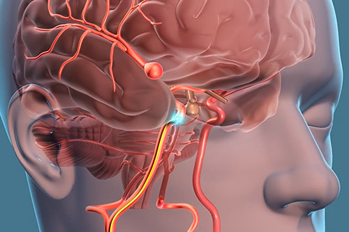 Aneurisma cerebral