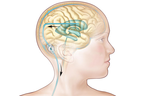 Hidrocefalia adultos e crianças